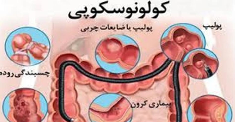 پایان کلونوسکوپی با استفاده ازقرص هوشمند