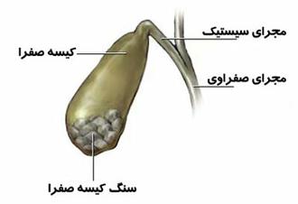 رژیم غذایی مناسب برای جلوگیری از سنگ صفرا