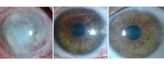 A cornea damaged by chemical burns. L-R: before treatment and at 3 and 12 months after. (Jurkunas et al., Science Advances, 2023)