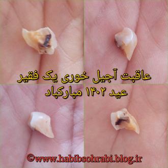 شکستن دندان در آجیل خوری عید ۱۴۰۲