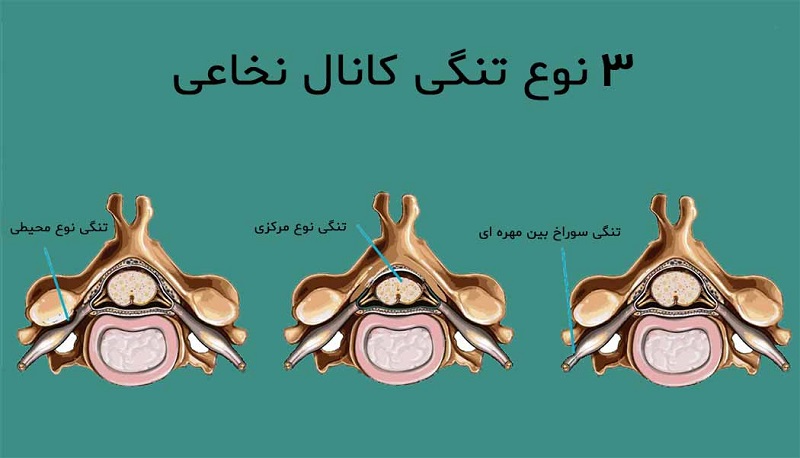 تنگی کانال نخاعی