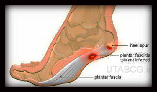 درد پاشنه در کوهنوردی؛ درد پاشنه بعلت فاسئیت پلانتار Plantar fasciitis بر اثر التهاب فاشیای پلانتار قوس کف پا