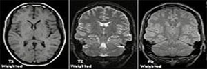 تشعشعات MRI در درمان افسردگی‌ها مؤثرست