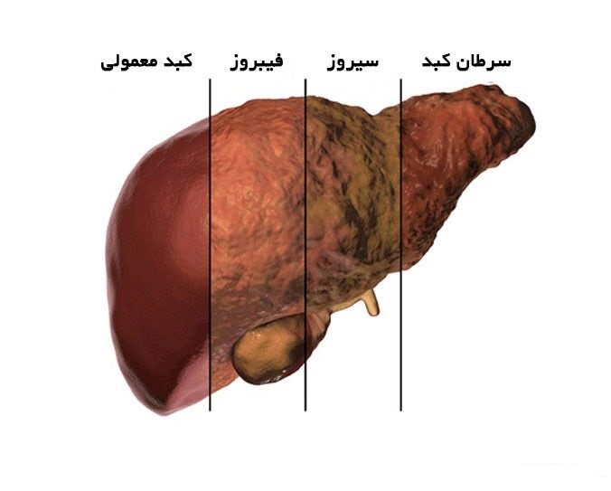 کبد چرب