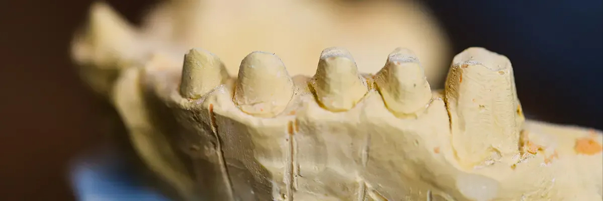 ۵ ویژگی مهم تراش روکش دندان پایه