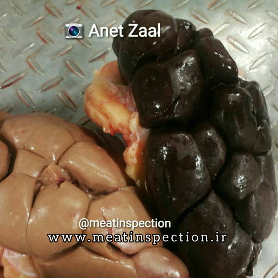 Hemosiderosis & Normal kidney