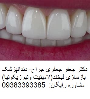 دندانپزشکی بازسازی لبخند لامینت کامپوزیت ونیر سفیدکردن دندان ایمپلنت ارتودنسی