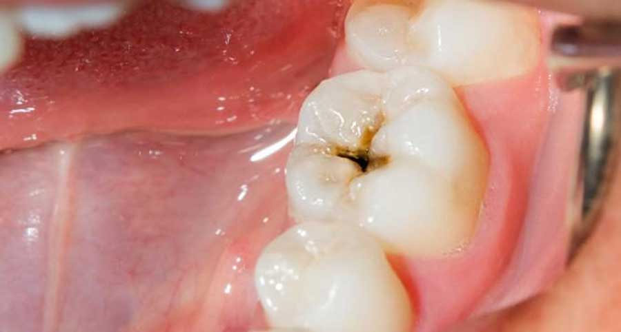علت اصلی پوسیدگی دندان چیست و چگونه جلوی آن را بگیریم؟