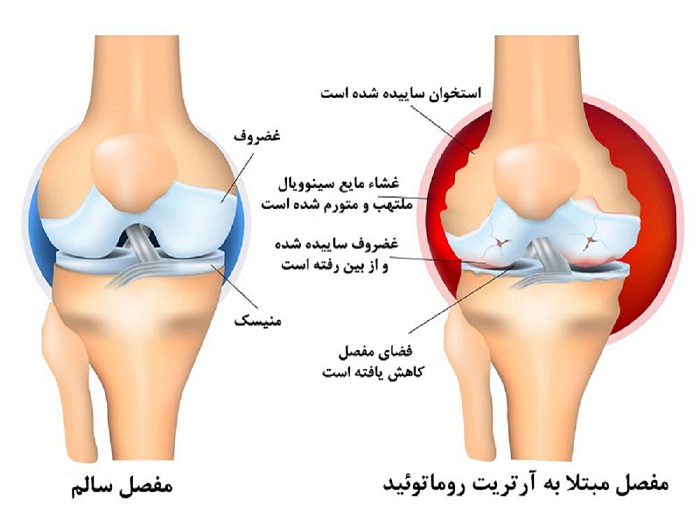 روماتیسم مفصلی 