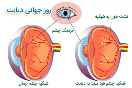 چشمان دیابتی 