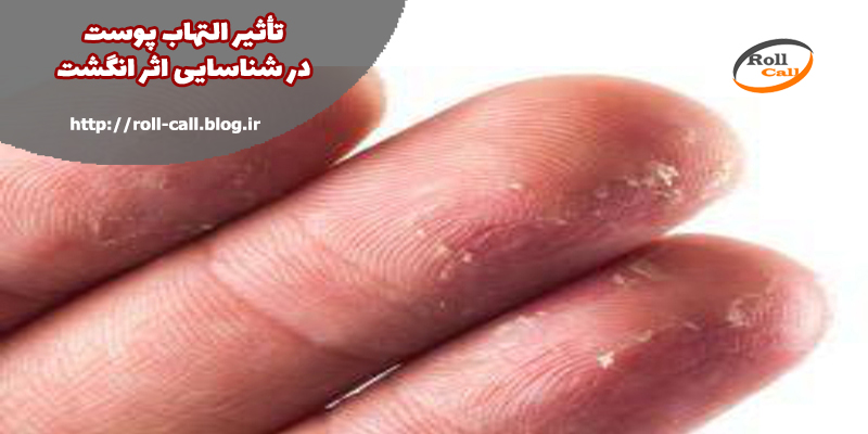 تاثیر التهاب پوست در شناسایی اثر انگشت