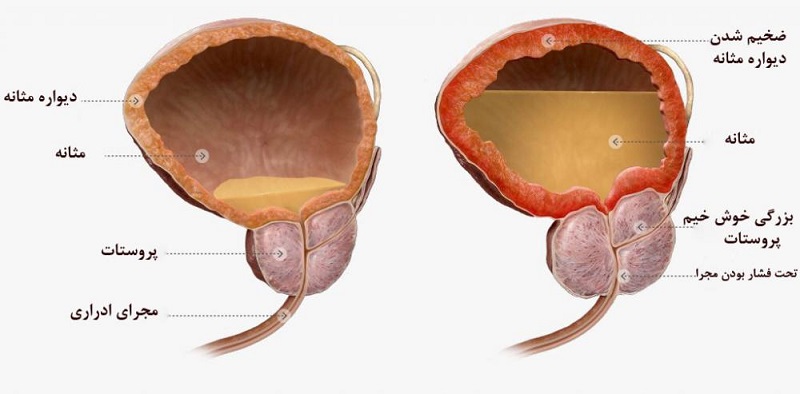 بزرگی پروستات