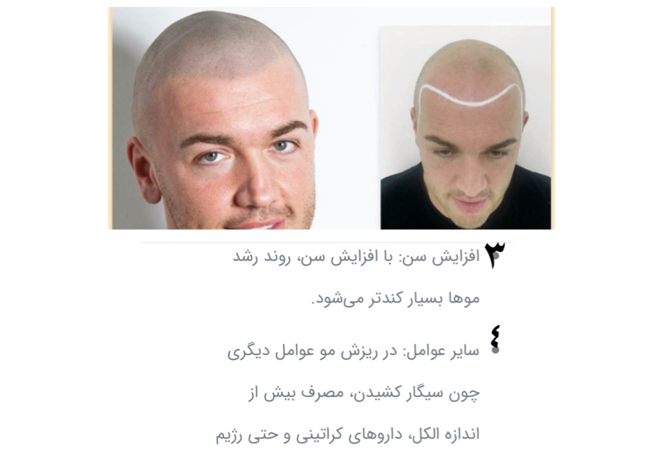 دلایل ریزش مو ٣