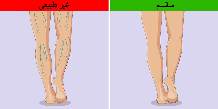6 تغییر شایع  در پاها که باید آنها را جدی گرفت
