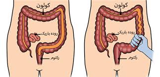 روده تحریک پذیر