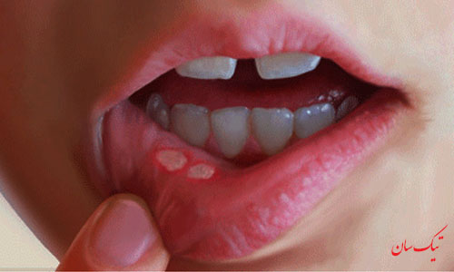 آیا برای درمان آفت دهان روش سریع تری وجود دارد؟