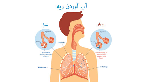 آب آوردن ریه 