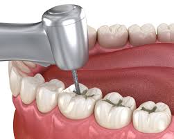 Dental_restoration