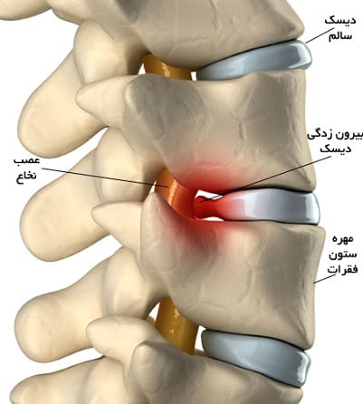 دیسک گردن 2