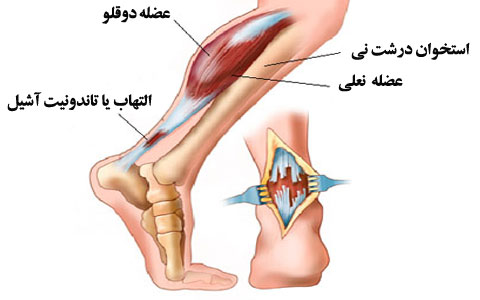 Image result for ‫آسیب های ساق پا‬‎