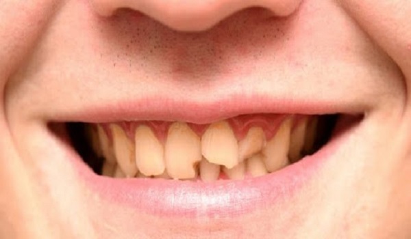 رفع مشکلات فعلی دندان برای جلوگیری از مشکلات بیشتر فردا