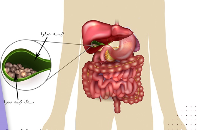 سینگ کیسه صفرا