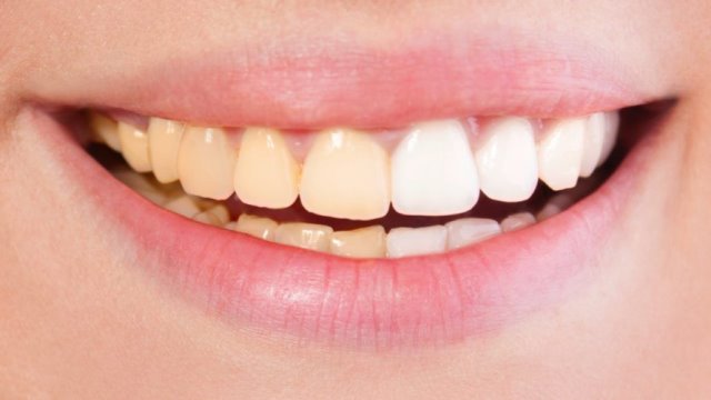 عادت‌های غلطی که باعث <strong>تغییر</strong> رنگ دندان‌ها می‌شوند