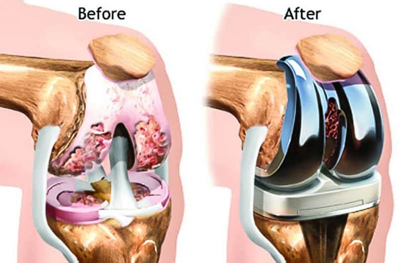 تعویض مفصل زانو