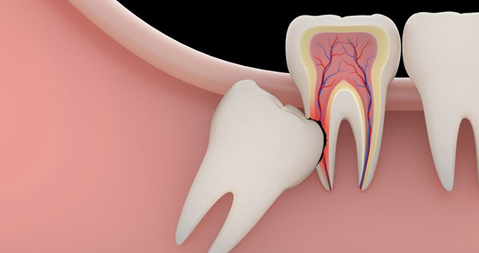 چند توصیه برای اینکه دندان عقل جراحی‌شده‌تان زودتر خوب شود