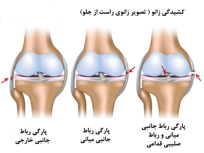 پارگی تاندون پا