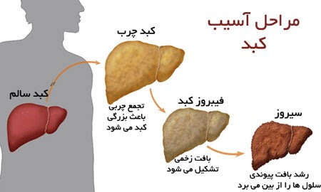 مراحل اسیب کبد