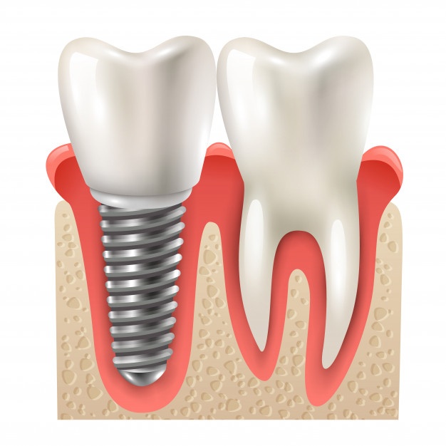 پایداری ایمپلنت دندان چقدر است؟ (ایمپلنت در مشهد)