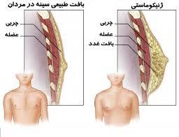 سرطان سینه در مردان