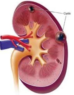 کیست‌های کلیه چگونه شناسایی می‌شوند؟