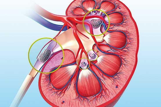 image of kidney stones from energy drinks