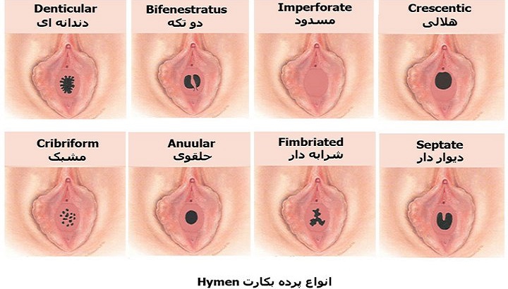 انواع مختلف پرده بکارت