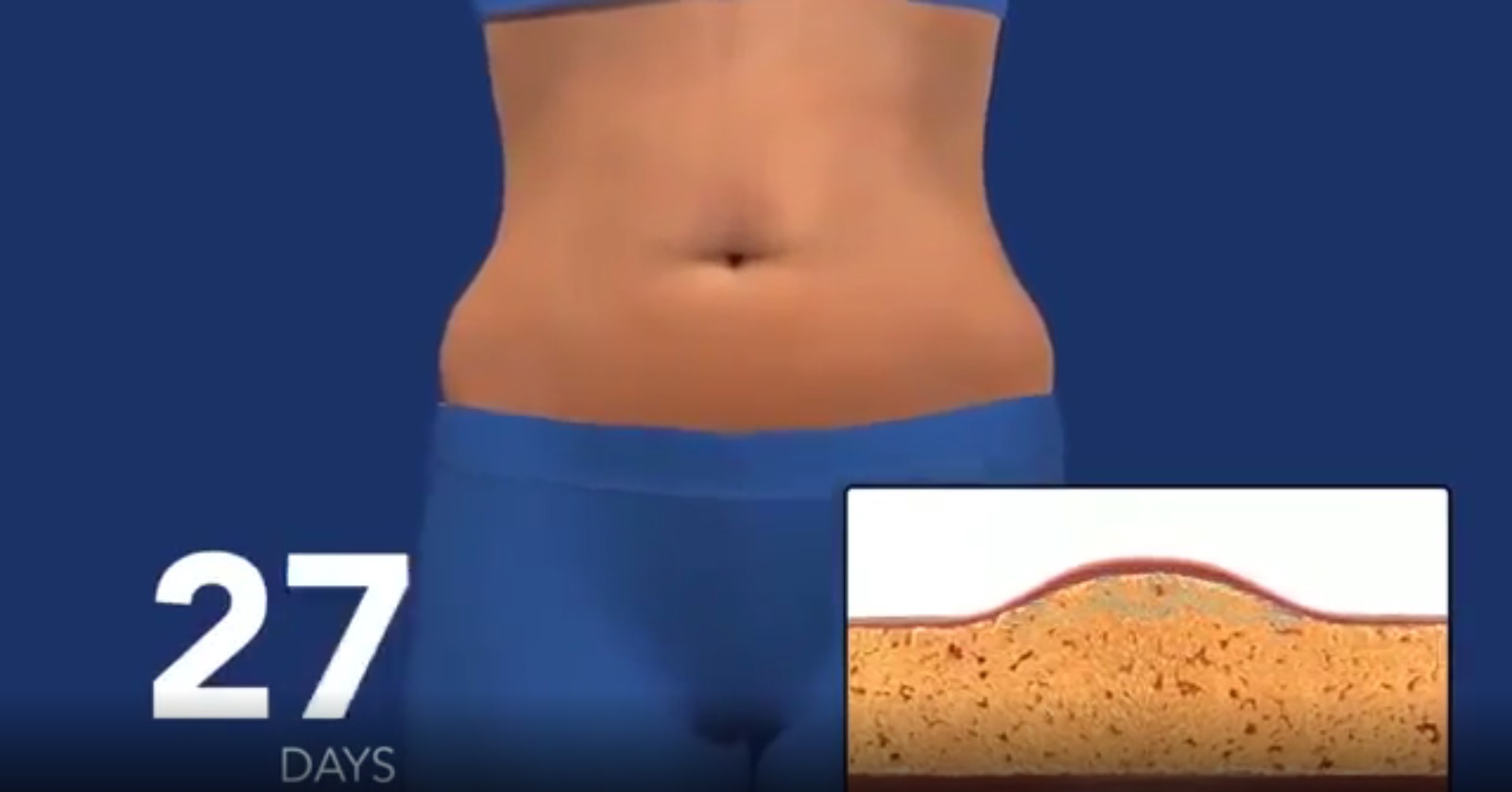 روش کرایولیپولیز در کلینیک لاغری راد