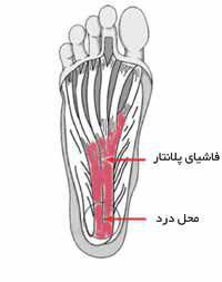 خار پاشنه پا