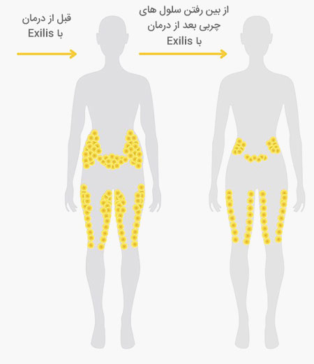 روش‌های درمان چاقی و لاغری موضعی
