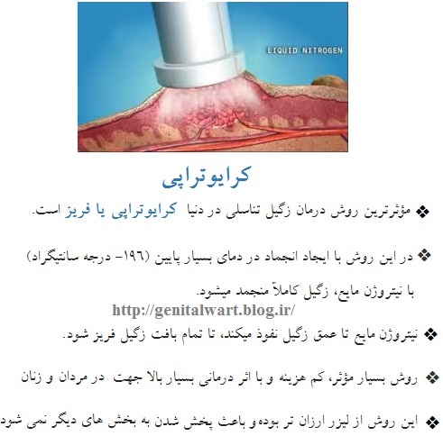 کرایوتراپی