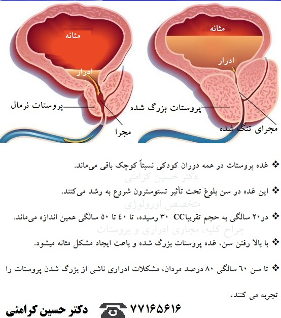 پروستات