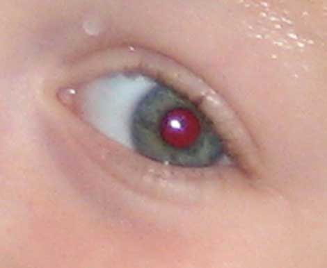 دلیل قرمز شدن چشم چیست؟ و چطور درمان کنیم