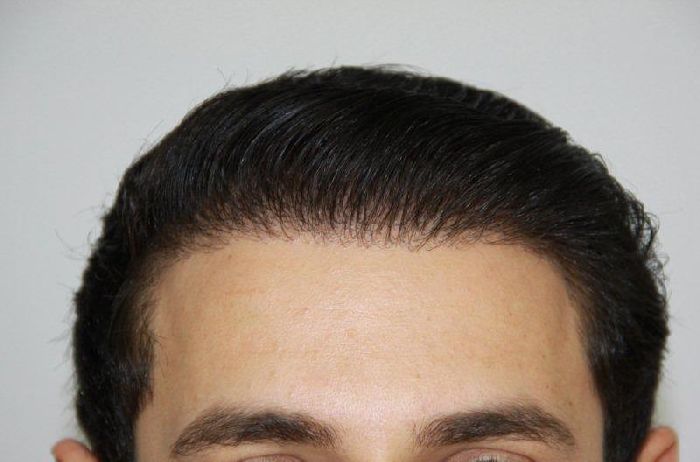 کاشت مو به روش fut