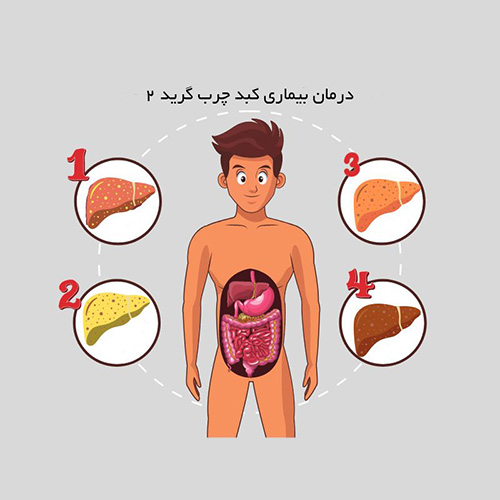 درمان کبد چرب گرید 2 با خاکشیر