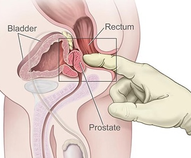 معاینه انگشتی در پروستات
