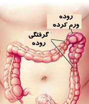روده تحریک پذیر