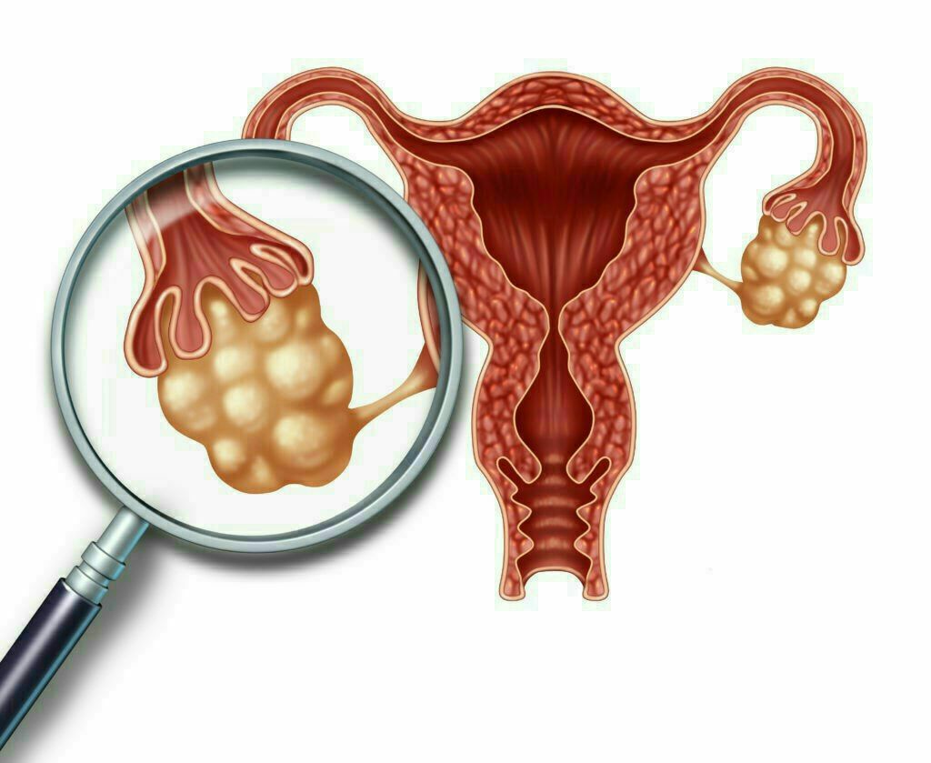 زنان مبتلا به PCOS در معرض اختلال در حفظ تعادل قند خون و مقاومت به انسولین هستند