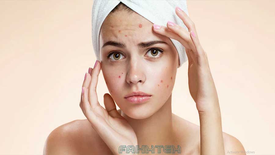 دلایل اصلی ایجاد لک، جوش و تیرگی های سطح پوست 