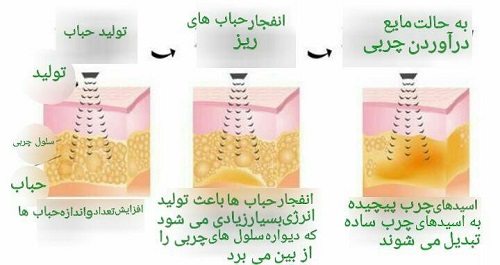مقایسه روش‏ های لاغری غیر تهاجمی